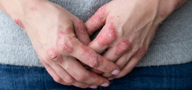 woman with psoriasis on hands