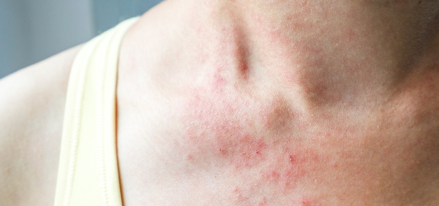 woman with rash