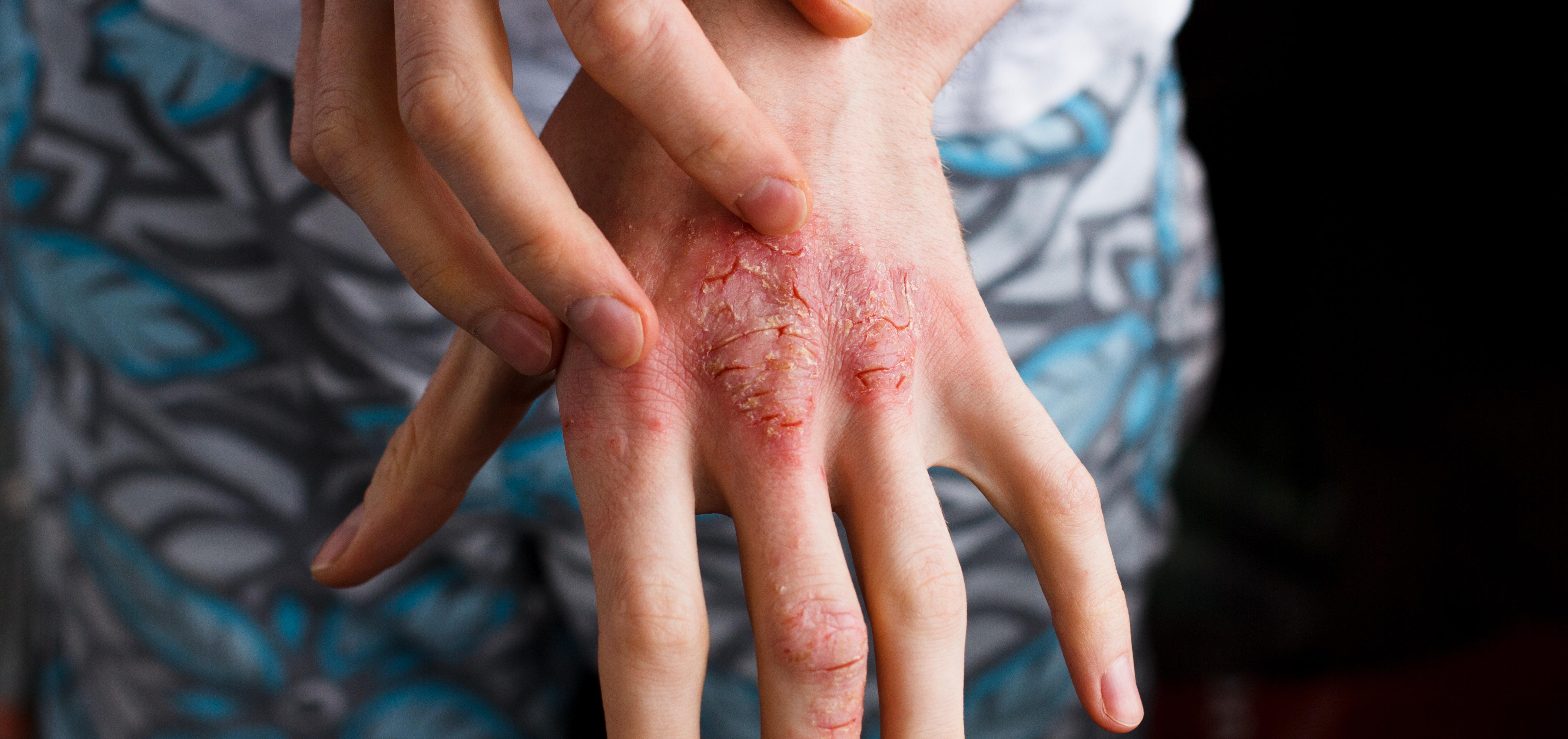 Person's hand with red, scaly, inflamed skin