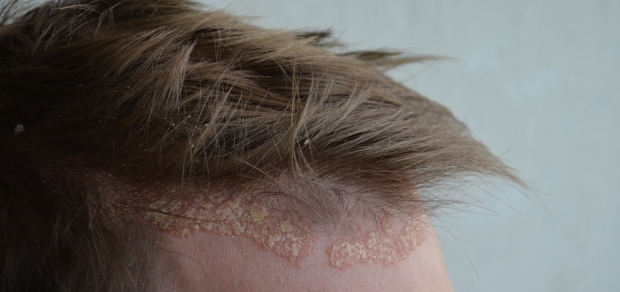 man with scalp psoriasis